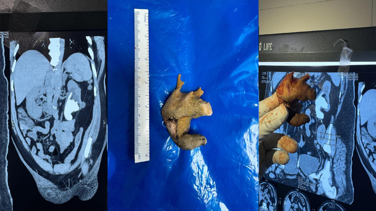 Vizag: దుప్పికొమ్ము ఆకారంలో రాయి.. ఏఐఎన్‌యూ వైద్యులు అరుదైన శస్త్ర చికిత్స