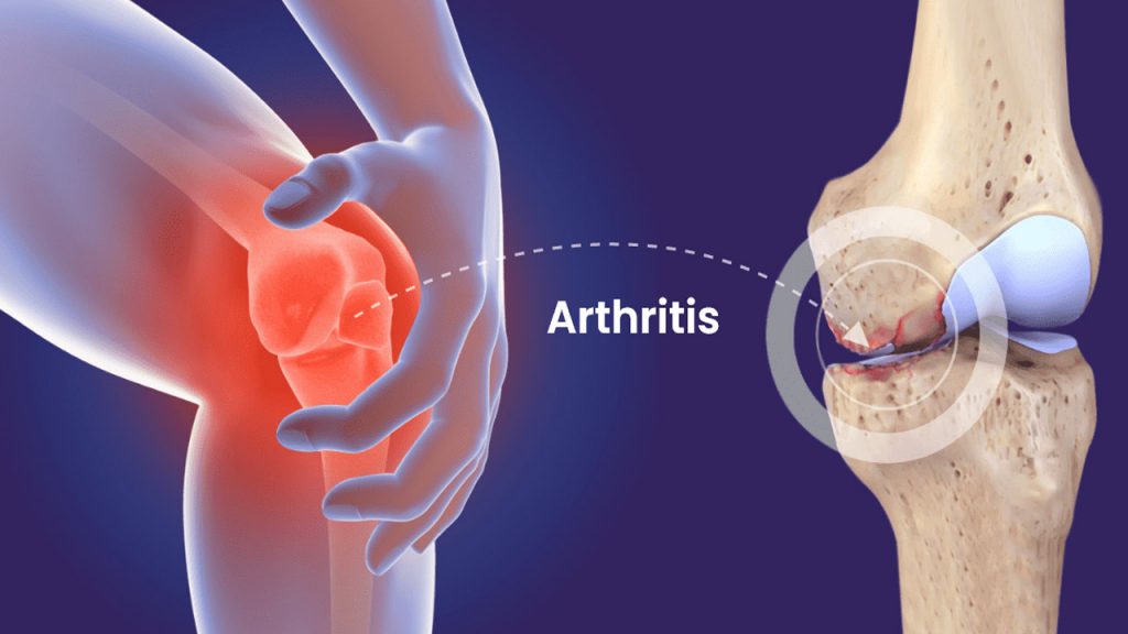 Arthritis