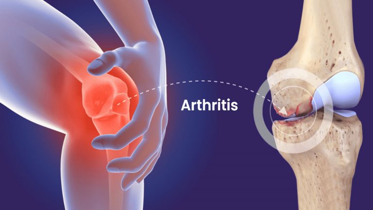 Arthritis: కీళ్ల నొప్పులతో బాధ పడుతున్నారా.. ఈ రెమెడీస్⁬తో నయం చేసుకోండి..!