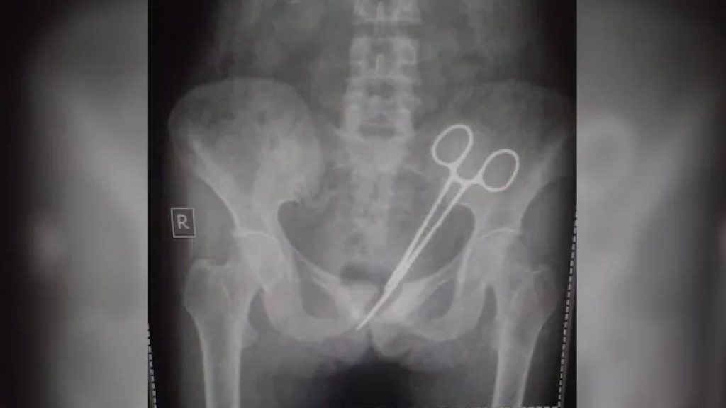 Scissors In Abdomen