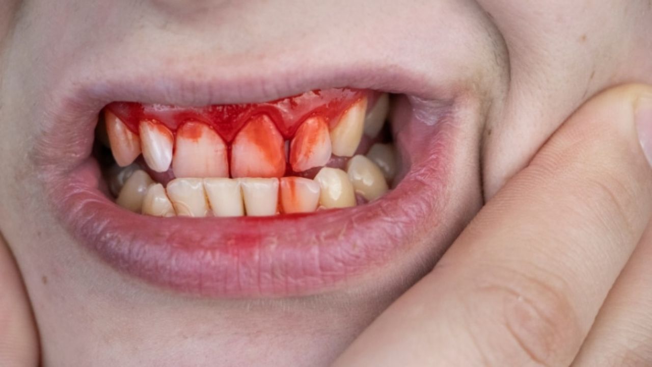 Reasons for Teeth Bleeding: దంతాల నుండి రక్తస్రావం ఎందుకు అవుతుందో తెలుసా.?