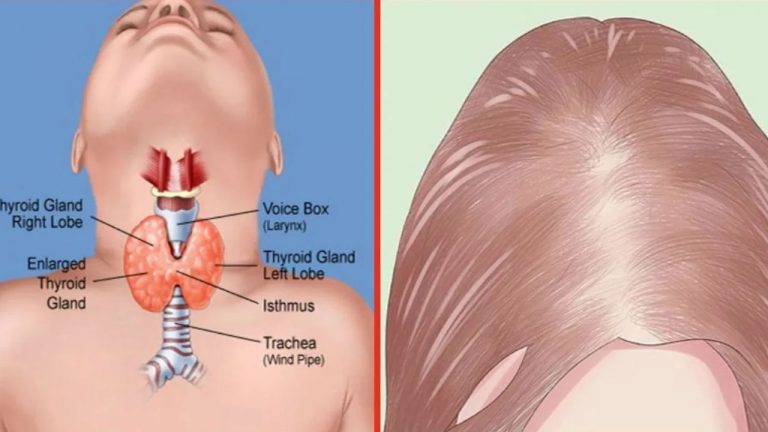 Can Thyroid Cause Hair Fall : థైరాయిడ్ కారణంగా జుట్టు విపరీతంగా రాలుతుందా?