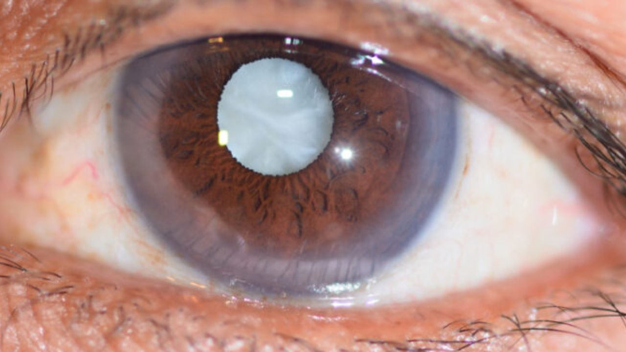 Diabetic Cataract Problem: డయాబెటిక్ పేషెంట్లలో కంటిశుక్లం ఎంత వరకు ప్రభావితం అవుతుందంటే?