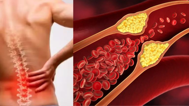 High Cholesterol: ఈ భాగాలలో నొప్పిగా ఉందా? అధిక కొలెస్ట్రాల్‌ కావచ్చు.. జాగ్రత్త సుమీ