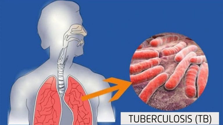 TB Disease: ప్రమాదకరంగా మారుతున్న ఈ అంటు వ్యాధి.. ప్రతి ఏడాది లక్షల్లో మృత్యువాత