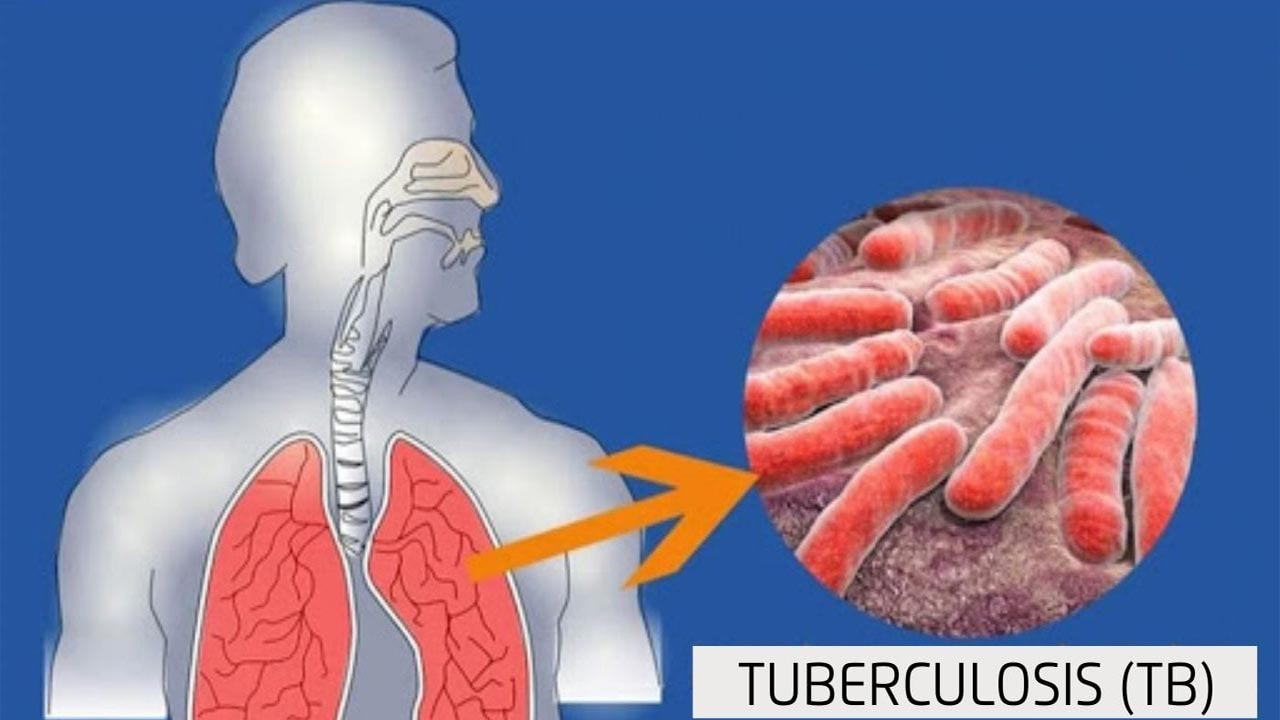 TB Disease: ప్రమాదకరంగా మారుతున్న ఈ అంటు వ్యాధి.. ప్రతి ఏడాది లక్షల్లో మృత్యువాత