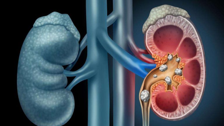 Kidney Stones: కిడ్నీలో రాళ్లు ఉండి ఇవి తిన్నారో.. ఇక దబిడి దిబిడే