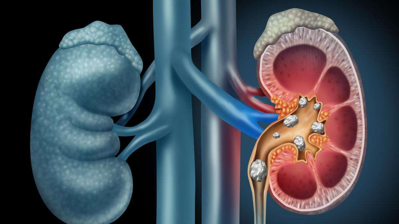 Kidney Stones: కిడ్నీలో రాళ్లు ఉండి ఇవి తిన్నారో.. ఇక దబిడి దిబిడే