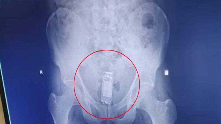 Gujarat: కంత్రీ ఖైదీ.. మొబైల్ ఎక్కడ దాచాడో తెలిస్తే షాక్ అవ్వాల్సిందే!