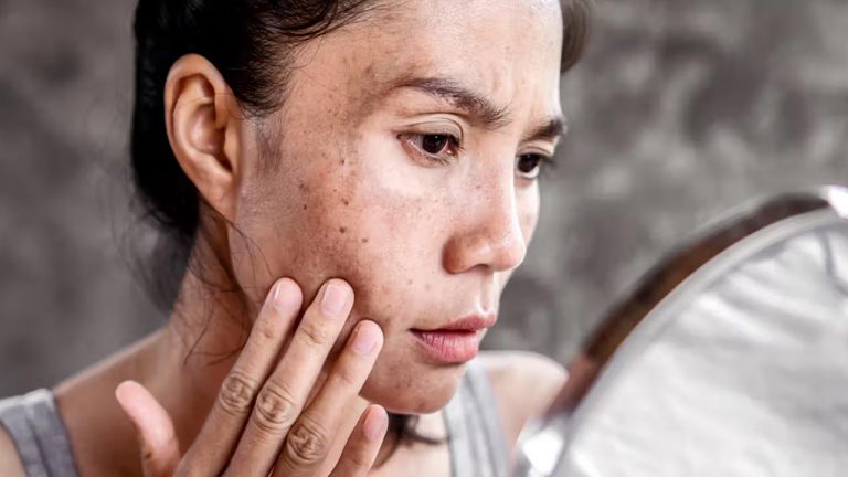 Beauty: ముఖంపై మొటిమలు, మచ్చలతో దరిద్రంగా ఉందా..? ఇంట్లో లభించే ఇవి వాడండి