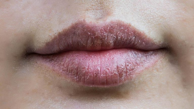 Lip Care Tips: చలికాలంలో పెదవులు పగులుతున్నాయా..? మృదువైన పెదాల కోసం ఇలా చేయండి