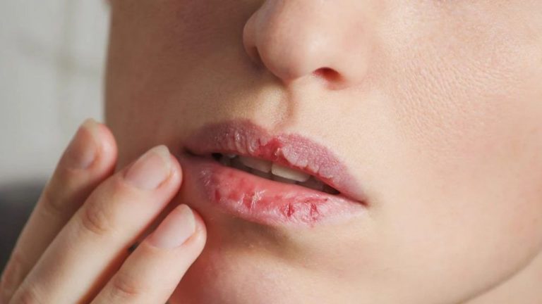Chapped Lips: పెదవులు పగిలియా? ఈ ఇంటి చిట్కాలు ట్రై చేయండి