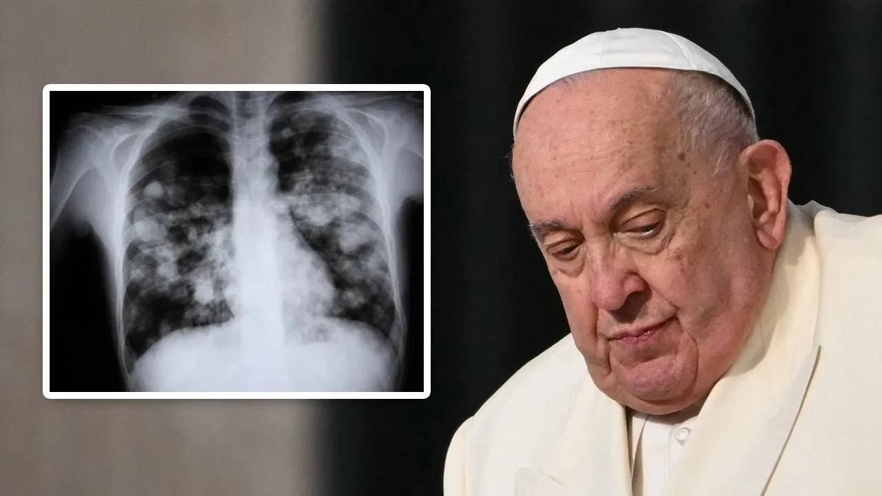 Pneumonia : ఆ వ్యాధితో బాధపడుతున్న పోప్.. దీని కారణంగా ప్రతేడాది ఎంతమంది చనిపోతున్నారో తెలుసా ?