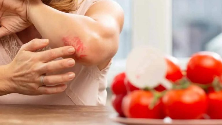 Health Tips: టమాటాలు తినడం వీరికి హానికరం.. పొరపాటున తిన్నారో చిక్కుల్లో పడ్డట్టే!