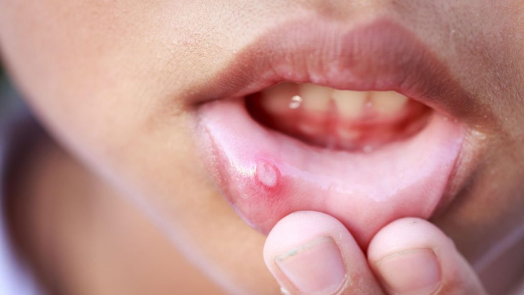 Mouth Ulcers
