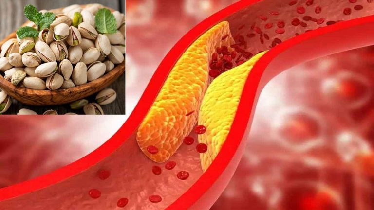 Pistachio Nuts: చెడు కొలెస్ట్రాల్ స్థాయిని తగ్గించి, మంచి కొలెస్ట్రాల్ పెరగాలంటే వీటిని తినాల్సిందే!