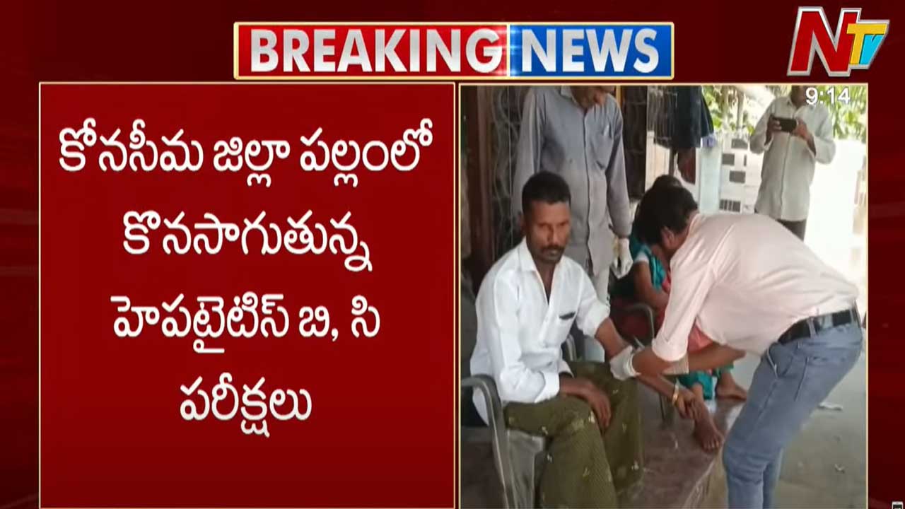 Hepatitis Test: కోనసీమ జిల్లాలో హైపటైటిస్ పరీక్షలు.. 205 మందికి పాజిటివ్