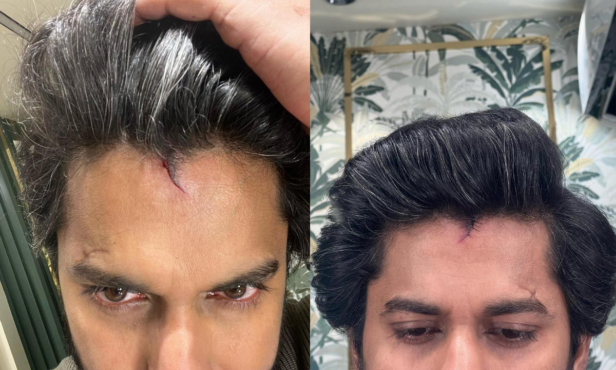 Hit3 : తలకు బలమైన దెబ్బ.. అయినా షూటింగ్ ఆపని నాని..