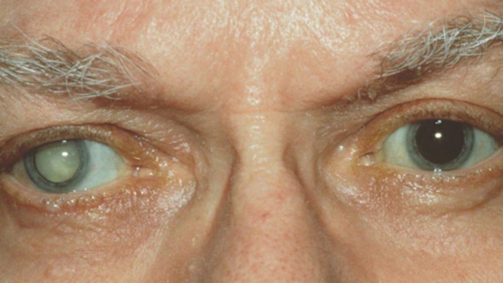 Cataract