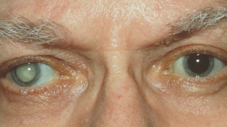 Cataract: కంటిశుక్లం హానికరమా..? కాదా..?