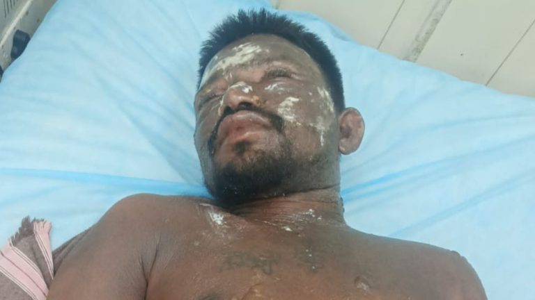 Domestic Violence: మరీ ఇలా తయారయ్యారేంట్రా.. భీమిలిలో భర్తపై వేడినీళ్లు పోసిన భార్య!