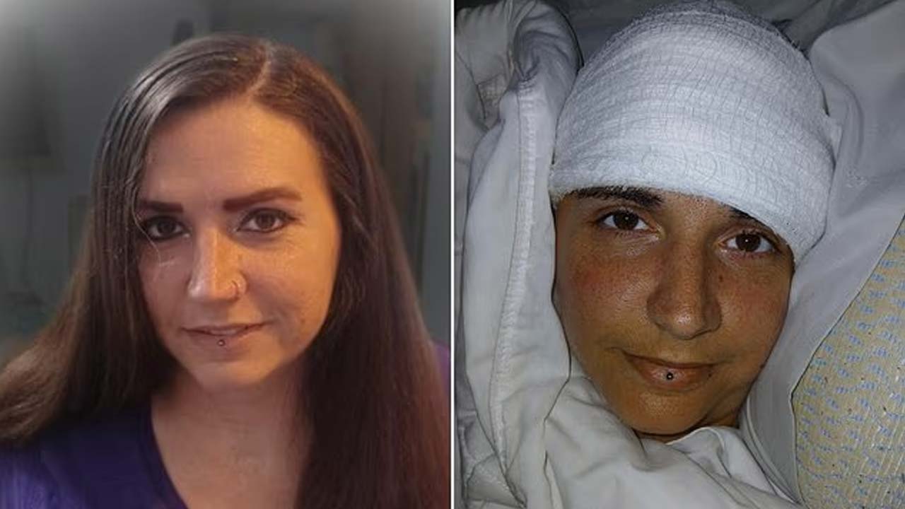 Elon Musk Neuralink: ఎలాన్ మస్క్ న్యూరాలింక్ అద్భుతం.. పక్షవాతానికి గురైన మహిళ 20 ఏళ్ల తర్వాత రాయగలిగింది