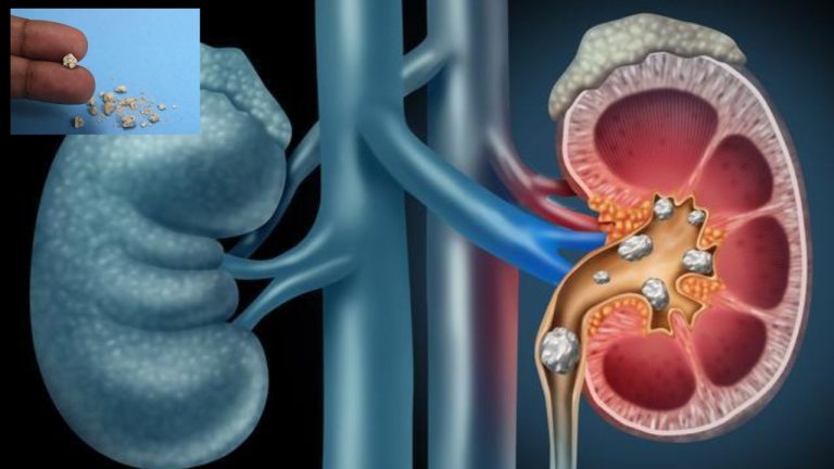 Kidney Stones Alert: వీటిని ఎక్కువ తింటున్నారా? అయితే కిడ్నీలలో రాళ్లు రావడం గ్యారెంటీ.. జాగ్రత్త సుమీ..!