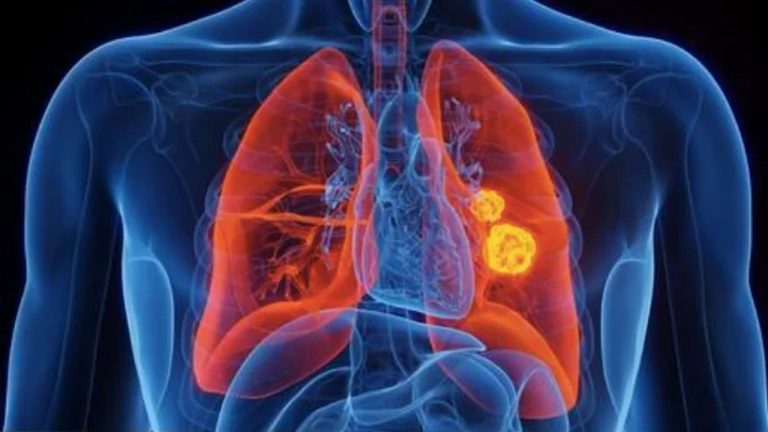 Lung Cancer: గాలిలోని ఆ పదార్థంతోనూ ఊపిరితిత్తి క్యాన్సర్..