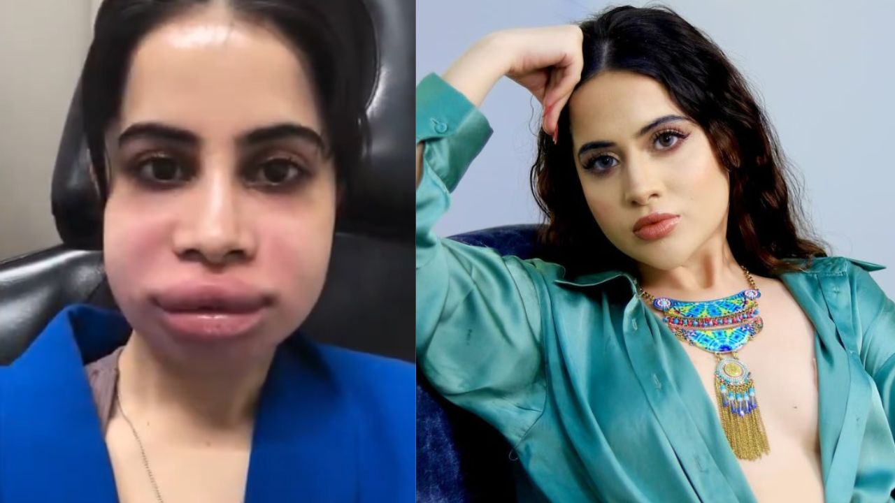 Urfi Javed : బెడిసికొట్టిన సర్జరీ.. గుర్తుపట్టలేనంతగా మారిపోయిన బోల్డ్ బ్యూటీ