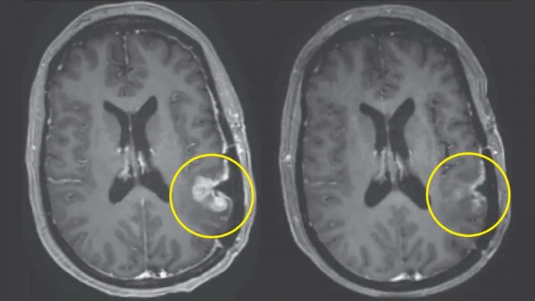 Brain Cancer: బ్రెయిన్ క్యాన్సర్ కు కొత్త చికిత్స.. ఒకే డోసుతో రోజుల్లోనే ట్యూమర్లు మాయం
