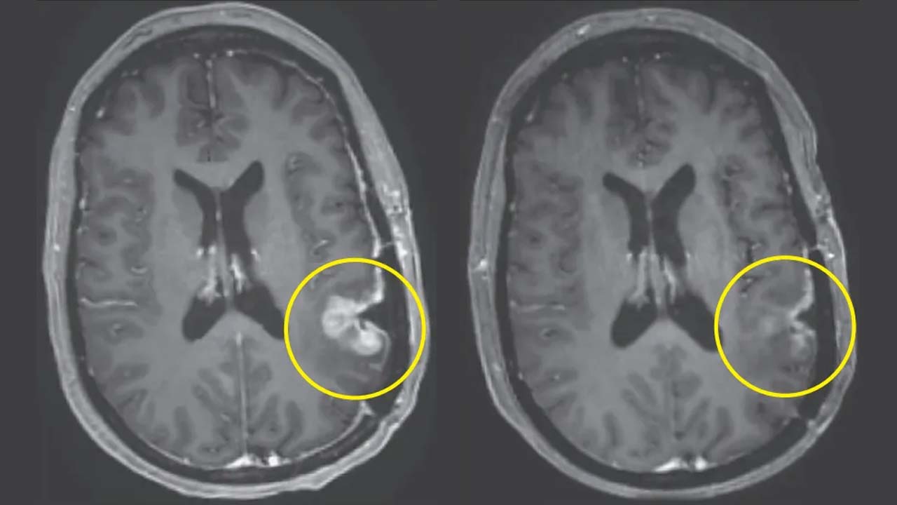 Brain Cancer: బ్రెయిన్ క్యాన్సర్ కు కొత్త చికిత్స.. ఒకే డోసుతో రోజుల్లోనే ట్యూమర్లు మాయం