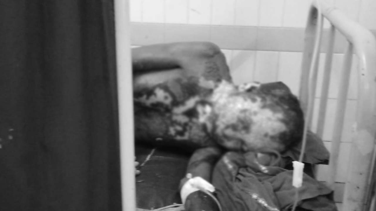 Mahabubabad: తల్లి కర్కషత్వం.. కొడుకు పై వేడి నీళ్ళు పోసి దారుణం.. కారణం అదే!