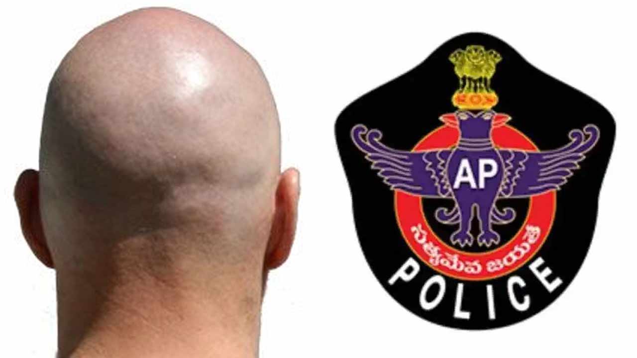 Hair Plantation Fraud: బట్టతల మీద జుట్టు తెప్పిస్తామంటూ గుండు గీయించారు..! పీఎస్‌కు బాధితుడు