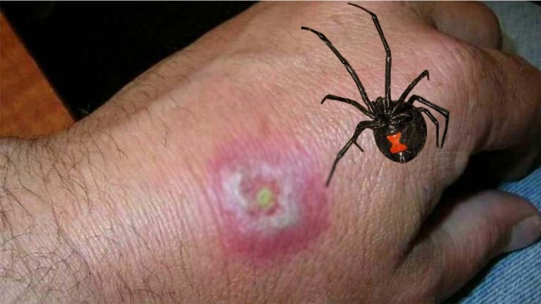 Spider Bite: షాకింగ్.. సాలీడు కాటు.. ఏడేళ్ల బాలిక మృతి!