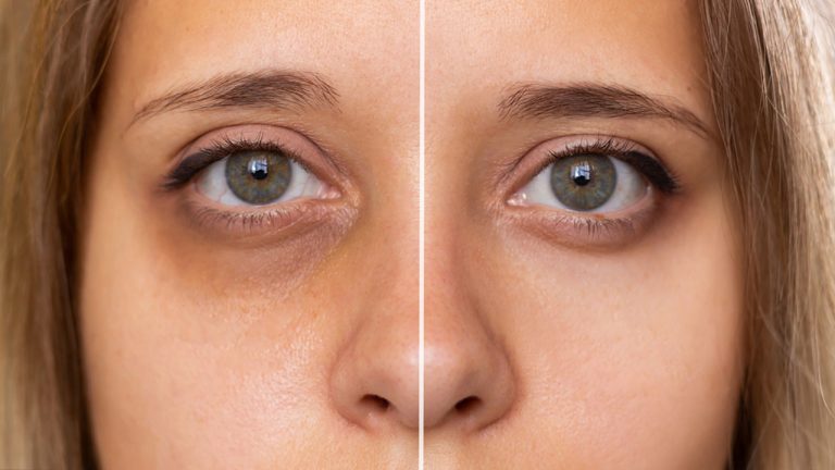 Dark Circles Natural Remedies: నల్లటి వలయాలు వేధిస్తున్నాయా?.. ఈ చిట్కాలు పాటించండి!