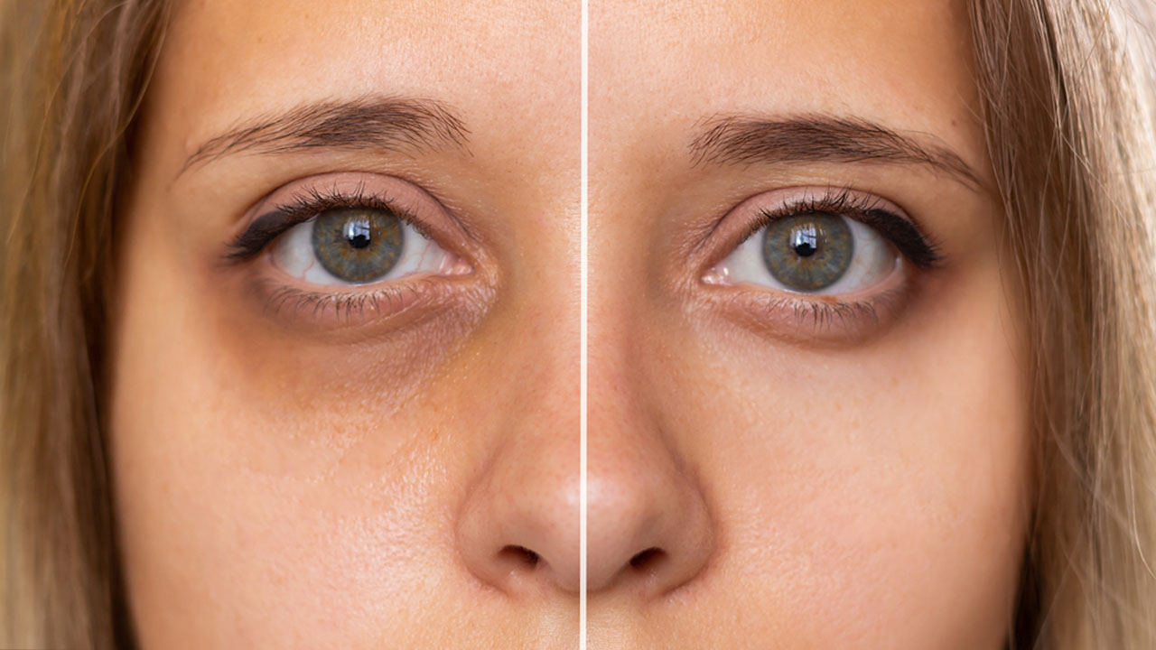 Dark Circles Natural Remedies: నల్లటి వలయాలు వేధిస్తున్నాయా?.. ఈ చిట్కాలు పాటించండి!