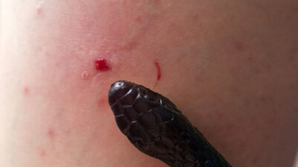 Snake Bite