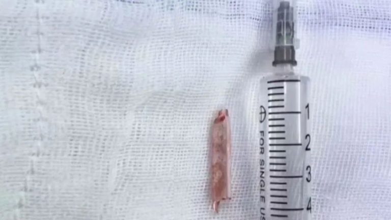 China: 22 ఏళ్లుగా మహళ బాడీలో  థర్మామీటర్ ముక్క