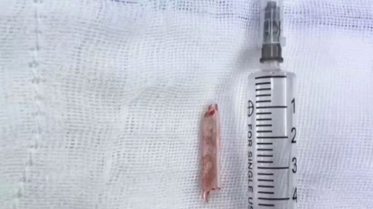 China: 22 ఏళ్లుగా మహళ బాడీలో  థర్మామీటర్ ముక్క