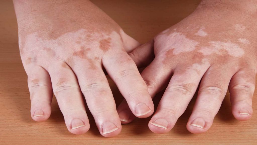 Vitiligo Disease