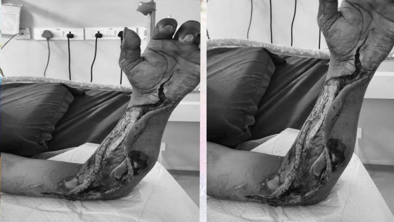 Sangareddy: కడుపునొప్పితో ప్రభుత్వ ఆస్పత్రికి వెళితే.. చేతికి ఇన్ ఫెక్షన్‌.. యువకుడి పరిస్థితి విషమం..