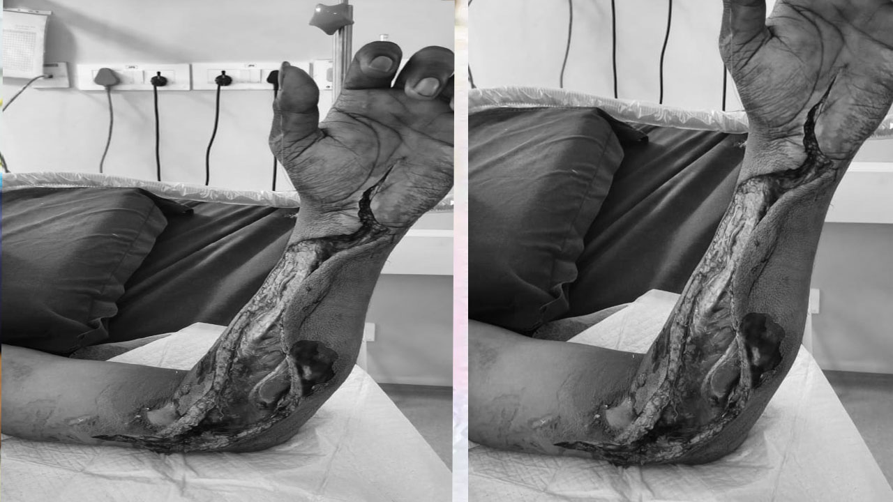 Sangareddy: కడుపునొప్పితో ప్రభుత్వ ఆస్పత్రికి వెళితే.. చేతికి ఇన్ ఫెక్షన్‌.. యువకుడి పరిస్థితి విషమం..