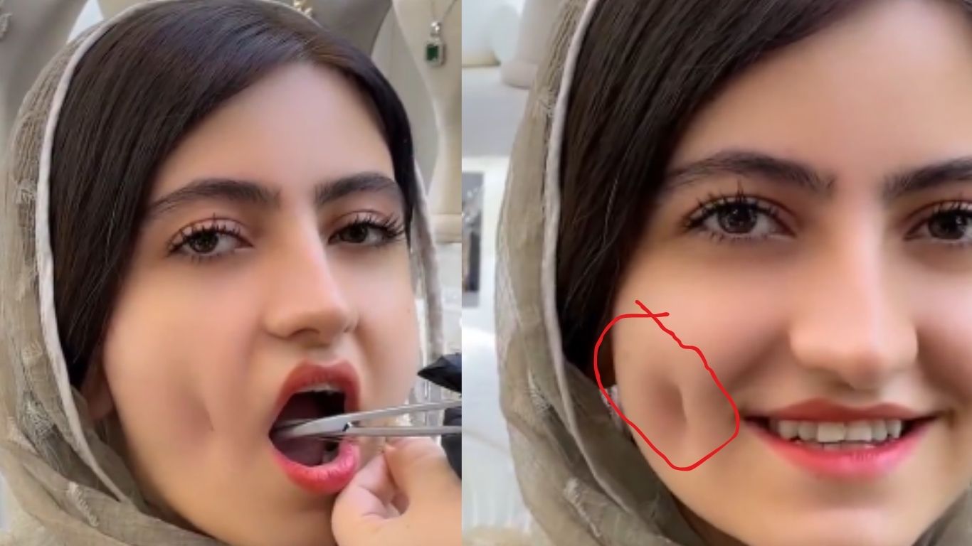 Dimpleplasty: సొట్ట బుగ్గల కోసం ఓ అమ్మాయి.. ఎంత పని చేసిందో తెలుసా..