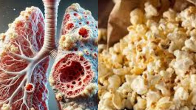 Popcorn Lung Disease:మీ పిల్లలకు పాప్ కార్న్ ఇప్పిస్తున్నారా.. అయితే జాగ్రత్త