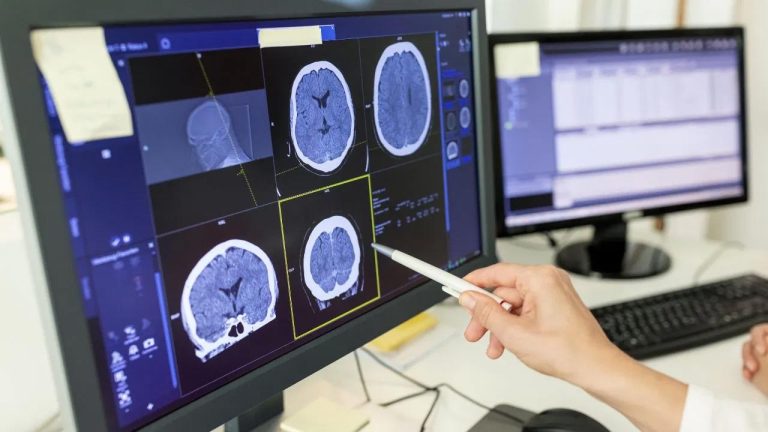 Brain Stroke: ఎవరికి బ్రెయిన్ స్ట్రోక్ ప్రమాదం ఎక్కువ..?