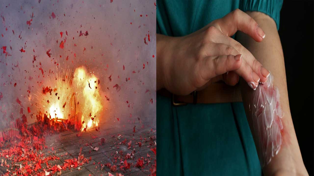 Diwali 2025: టపాకాయలు కాల్చడంలో గాయాలయ్యాయా..? ఇంటి వద్దే సురక్షిత చికిత్స ఇలా చేసుకోండి.!