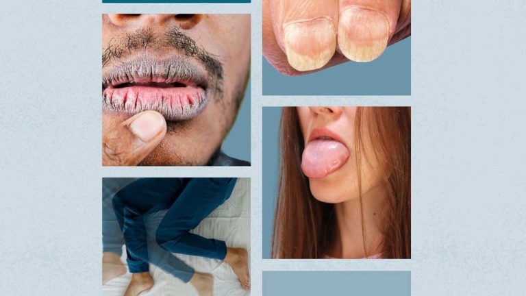 Iron Deficiency Symptoms: ఈ లక్షణాలు ఉంటే మీకు ఐరన్ లోపం ఉన్నట్లే..