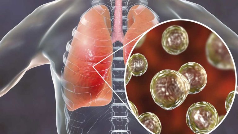 Lung Infection: ఊపిరితిత్తుల ఇన్ఫెక్షన్ ఎందుకు వస్తుందో తెలుసా?