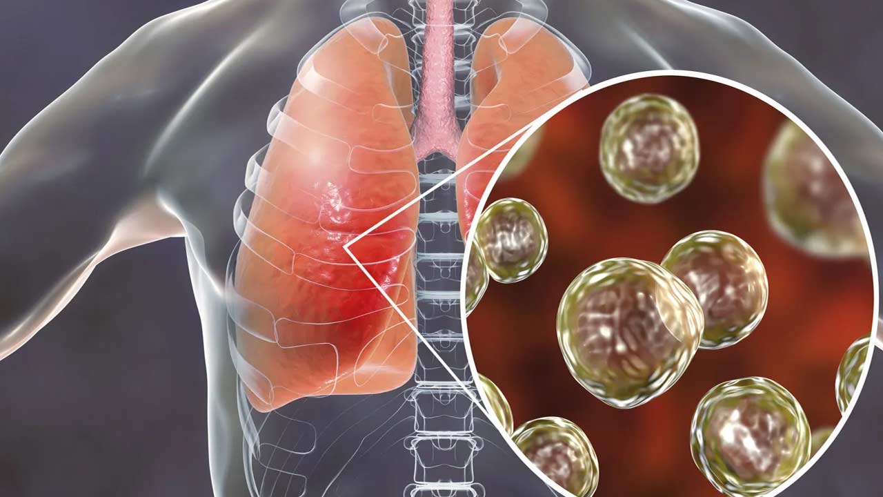 Lung Infection: ఊపిరితిత్తుల ఇన్ఫెక్షన్ ఎందుకు వస్తుందో తెలుసా?