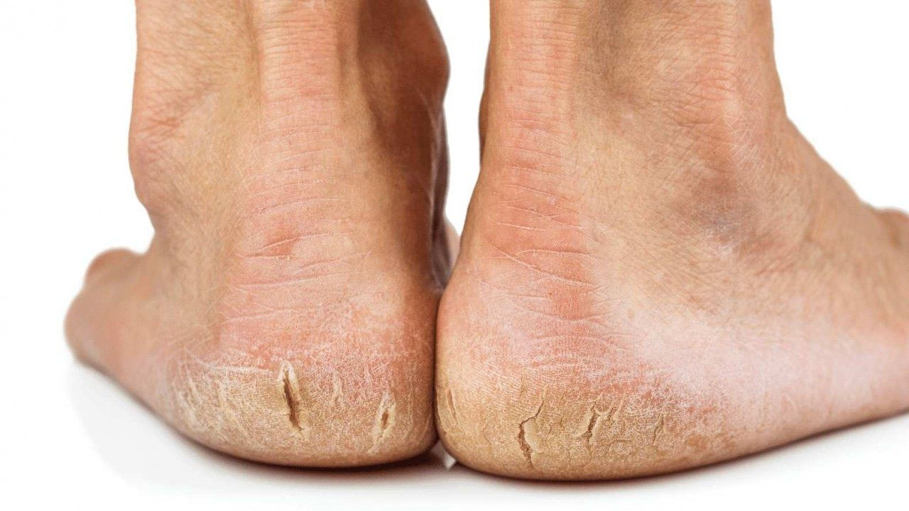 Cracked Heels Home Remedies: శీతాకాలం వచ్చేసింది..! మీ మడమలు పగలకుండా ఈ జాగ్రత్తలు తీసుకోండి..